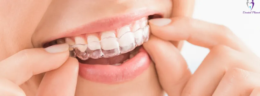 Invisalign Treatment Duration: How Fast Can You See Results?